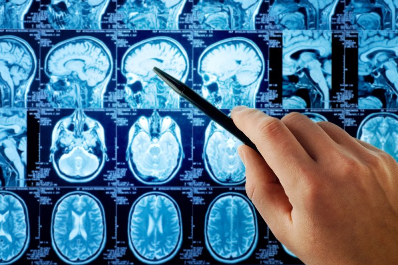 Ilmuwan Lakukan Uji Coba untuk Cara Kerja Obat Baru Lawan Tumor Otak