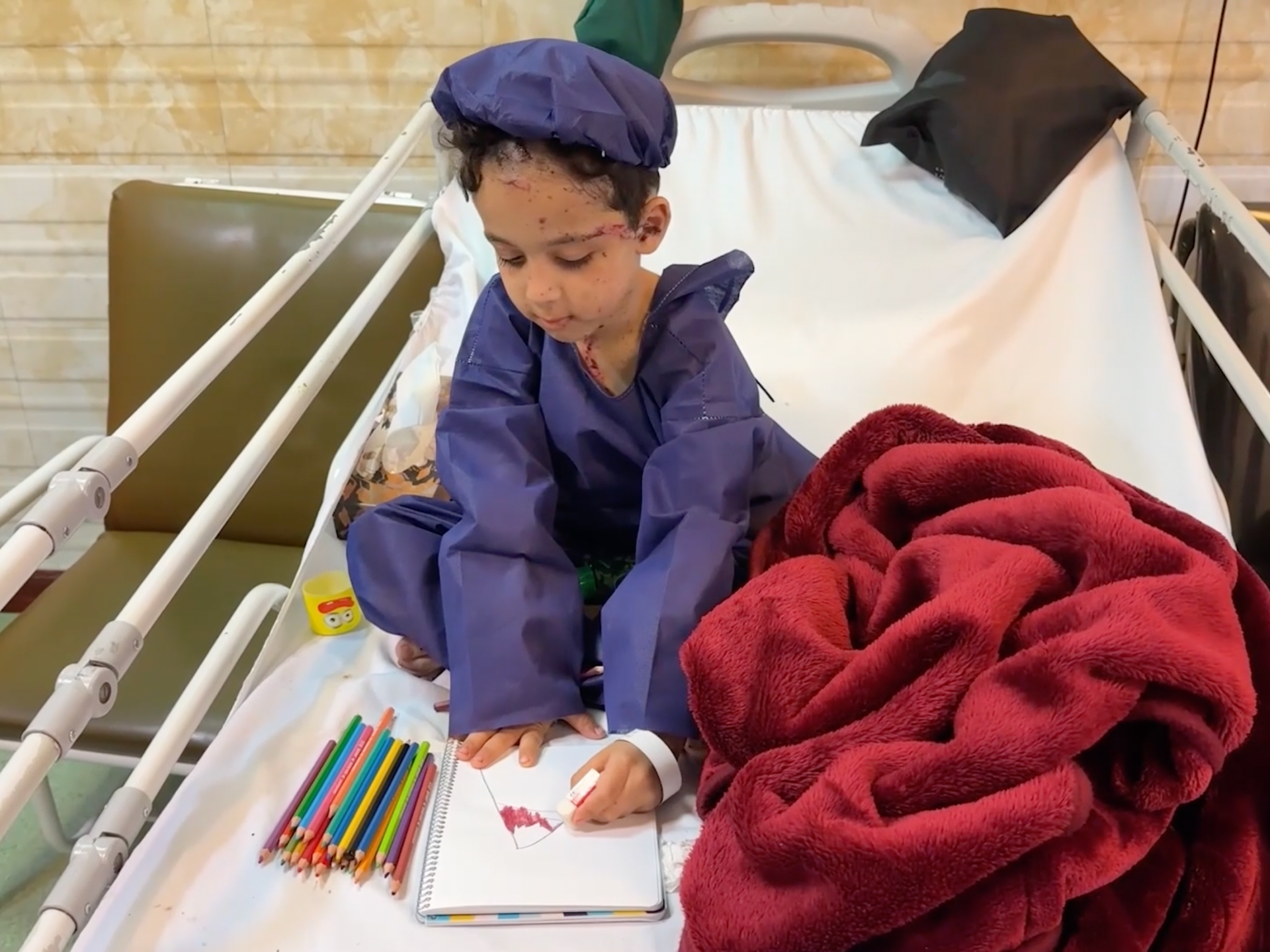 Children wounded in the US-Israeli strikes receive treatment in Tehran