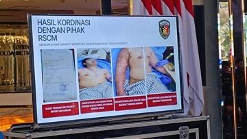 RSCM Ungkap Kondisi Luka Bakar Andrie Yunus Membaik Signifikan